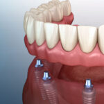 Same-Day Dental Implants: Say Hello To Your New Smile